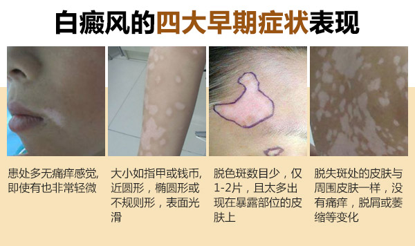 白癜風的主要癥狀有哪些