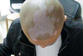 怎樣避免白癜風的病情加重