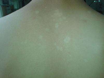 怎么治后背突然長的白斑