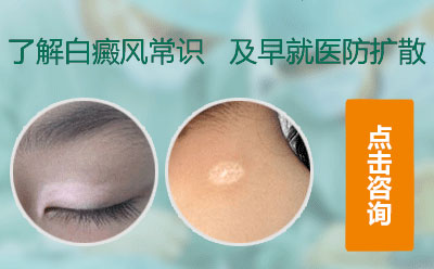 兒童白癜風，白癜風治療